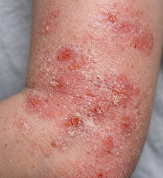 Skin pain