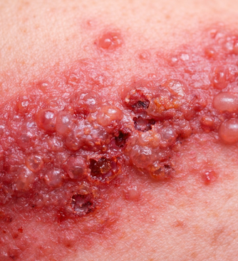 Skin pain
